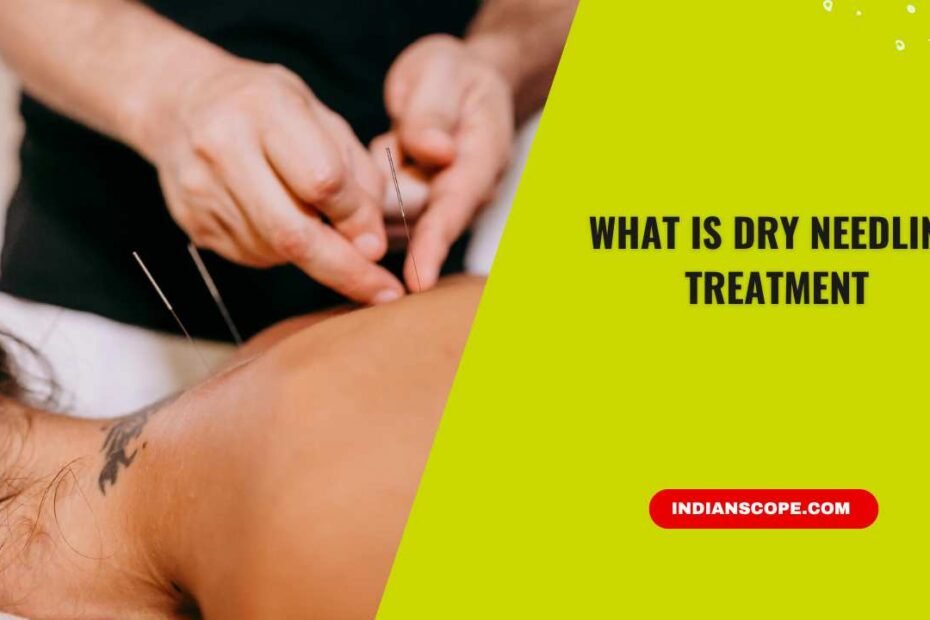 What Is Dry Needling Treatment? Benefits, Uses & Safety 2 What Is Dry Needling Treatment